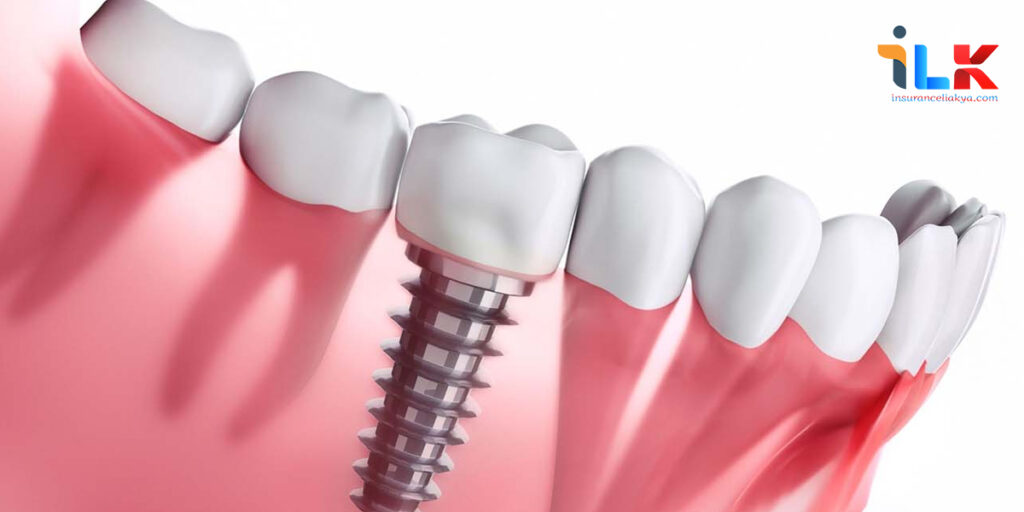 Dental-Implants