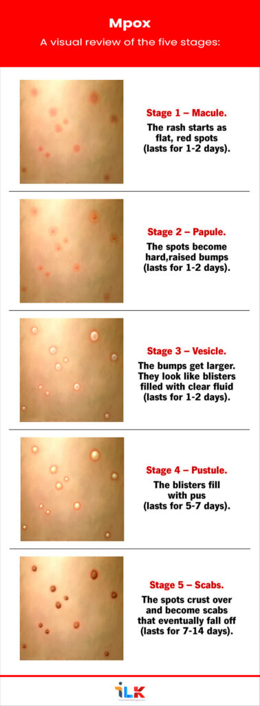 Monkeypox stages